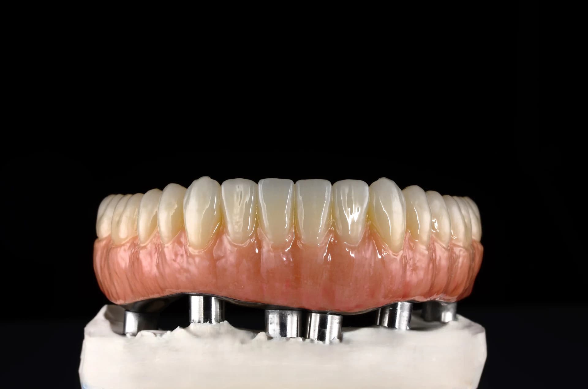 Full-arch restoration on a laboratory model, frontal view