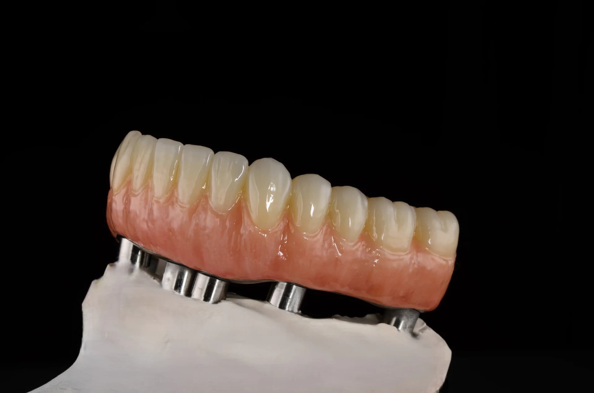 Full-arch restoration on a laboratory model, left-side view