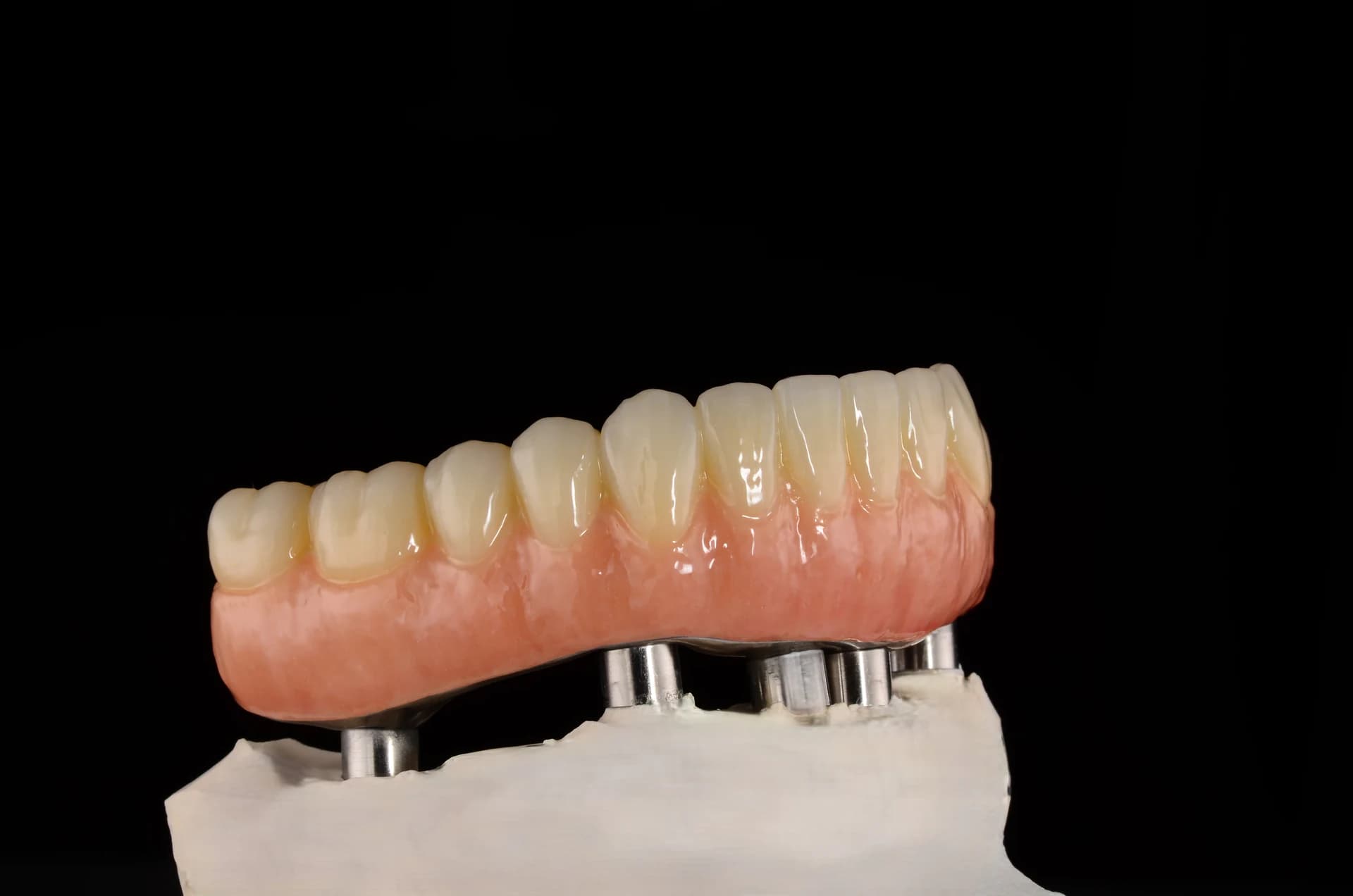 Full-arch restoration on a laboratory model, right-side view