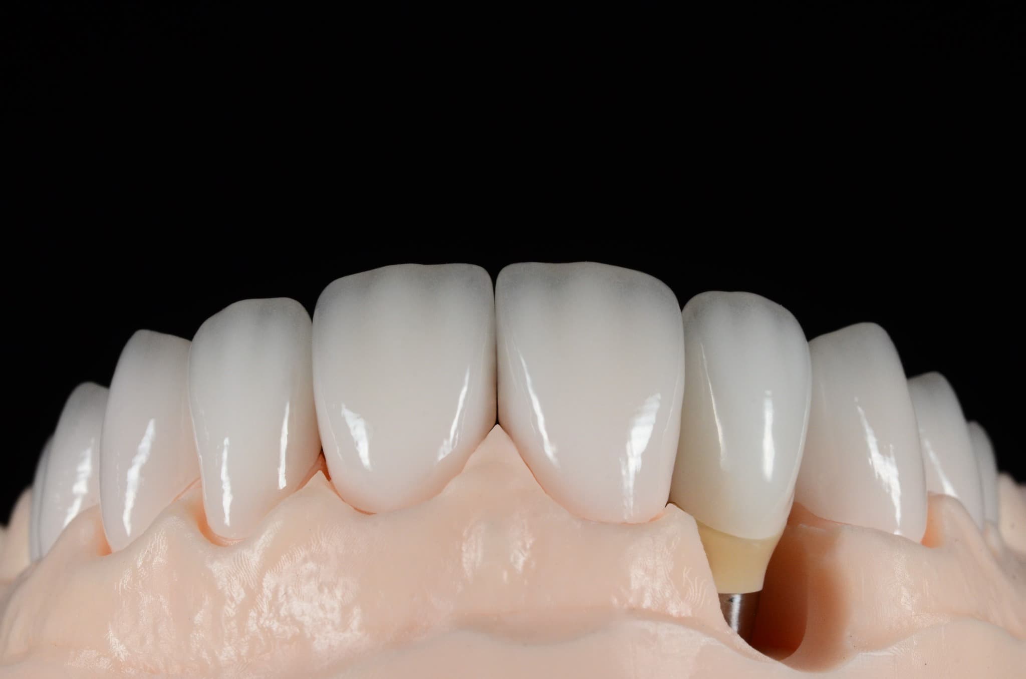 Przykładowe prace protetyczne